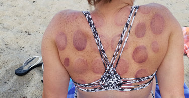 Cupping Marks...Bruises or Not?