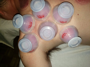 Live Online: Evidence Informed Clinical Cupping - Levels 1-4 - 16 hours
